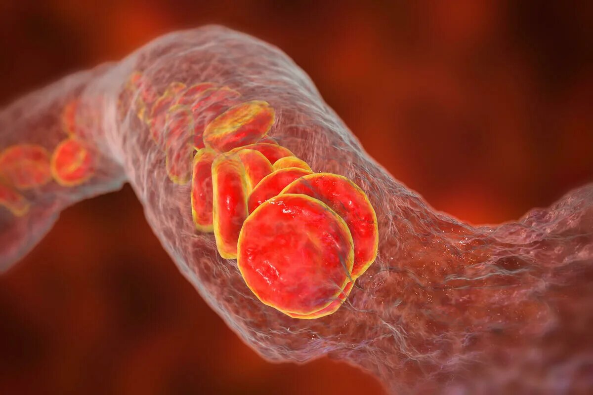 AHA и ACC обновили подходы к диагностике и лечению тромбоэмболии легочной артерии