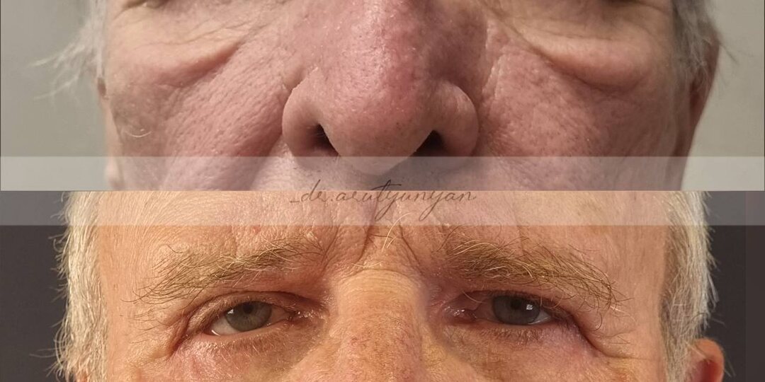 Мужская блефаропластика - это не только про молодость, это про уверенность