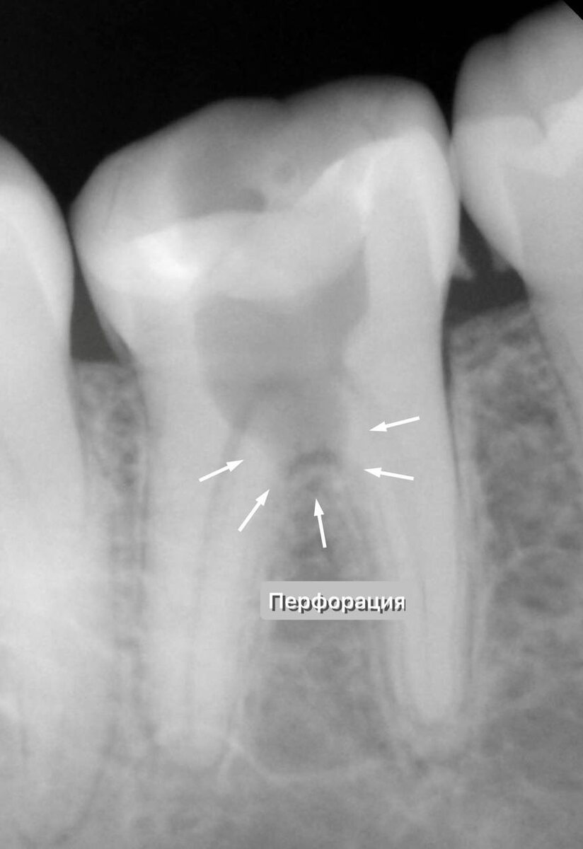Перфорация дна полости зуба в зоне бифуркации