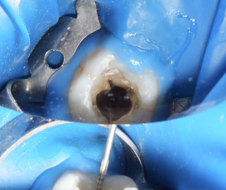 Убрали прошлую пломбу