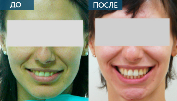 Исправление прикуса до и после лечения
