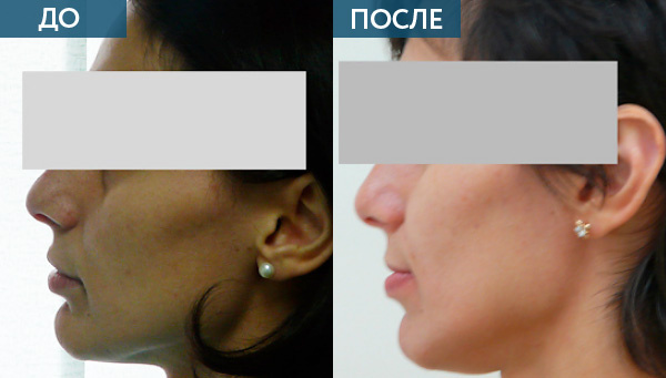 Глубокий прикус, исправление