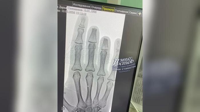 В Шахтах девушка лишилась двух пальцев из-за падения стола в кафе. Видео © Telegram-канал «Это Ростов Новости»