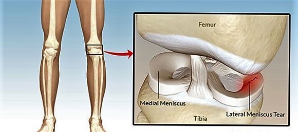 Что такое мениск и из-за чего он может повредиться: диагностика, лечение и реабилитация