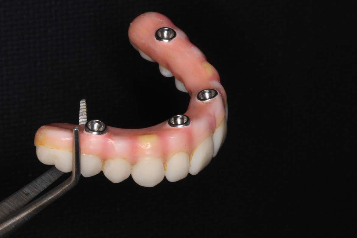 Все на 4-х имплантатах- это когда целый зубной ряд восстанавливаться всего на 4-х опорах