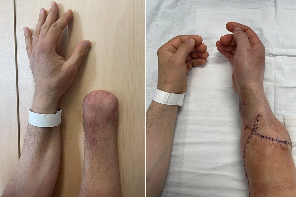    Руки первого пациента после операции. Фото: Департамент здравоохранения г. Москвы