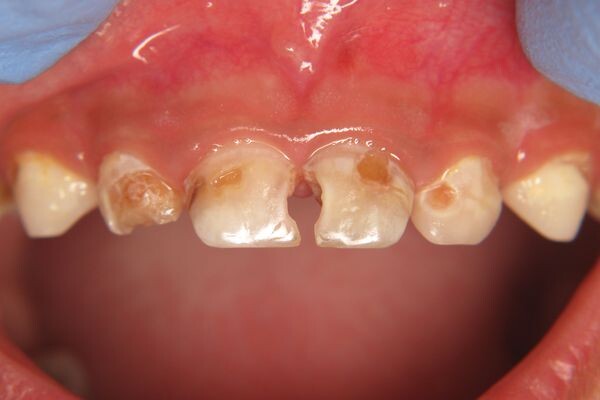 Поражения зубов при бутылочном кариесе