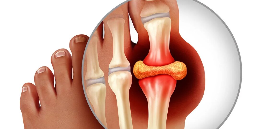 Подагра: разбор от первого приступа до хронической стадии