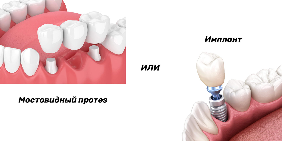 Мост или имплантат: что выбрать?
