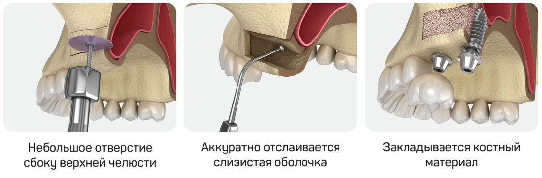 Один из самых частых вопросов — про синус-лифтинг. Простыми словами, это увеличение объема кости по высоте на верхней челюсти.