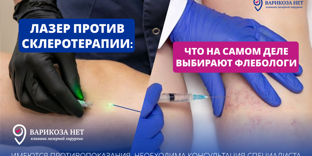 Лазер против склеротерапии: что на самом деле выбирают флебологи