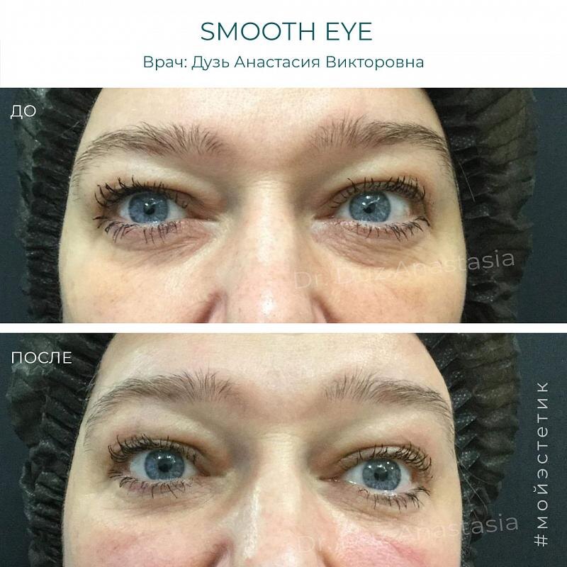 Результат лазерной блефаропластики (фото принадлежит Дузь А.В.)