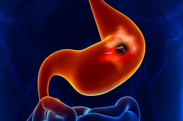    Сколько живут с раком желудка 4 стадии?