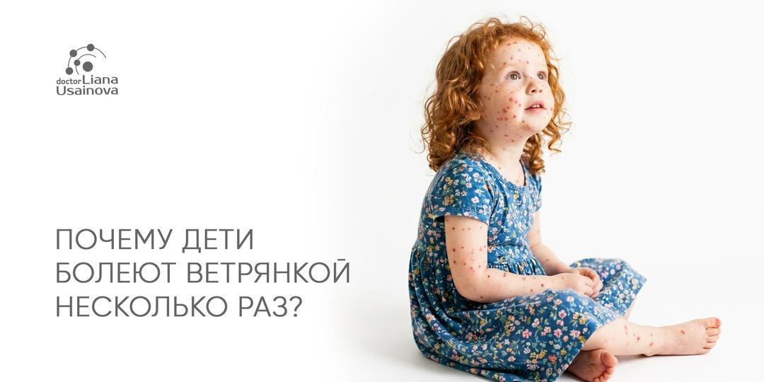Почему дети болеют ветрянкой несколько раз? Рассказывает Эндокринолог.