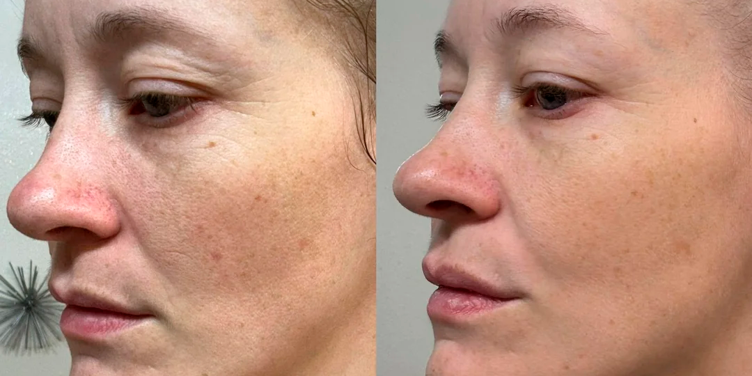 Они делают лицо лучше: результат использования микротоков. Фото До/После