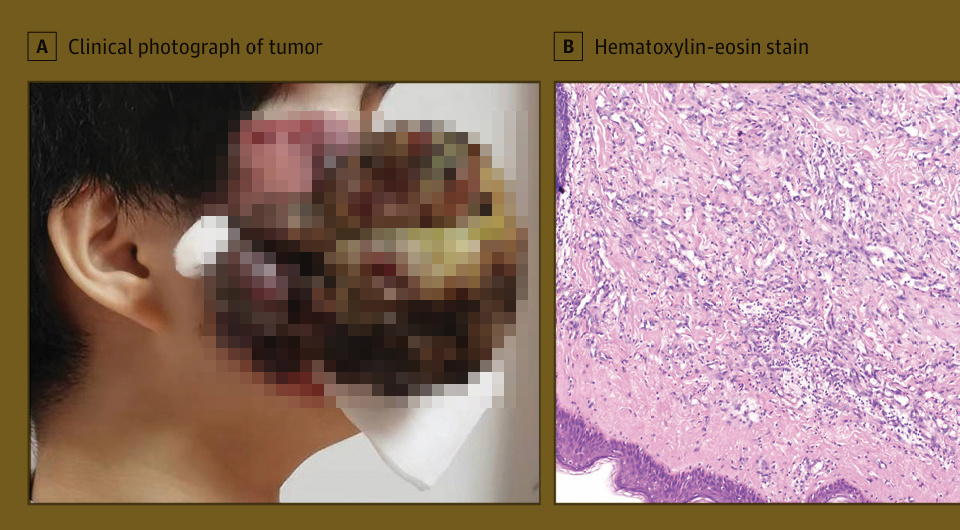   N + 1; Yuxi Chen et al. / JAMA Otolaryngology – Head & Neck Surgery, 2026