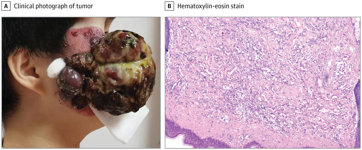   Yuxi Chen et al. / JAMA Otolaryngology – Head & Neck Surgery, 2026
