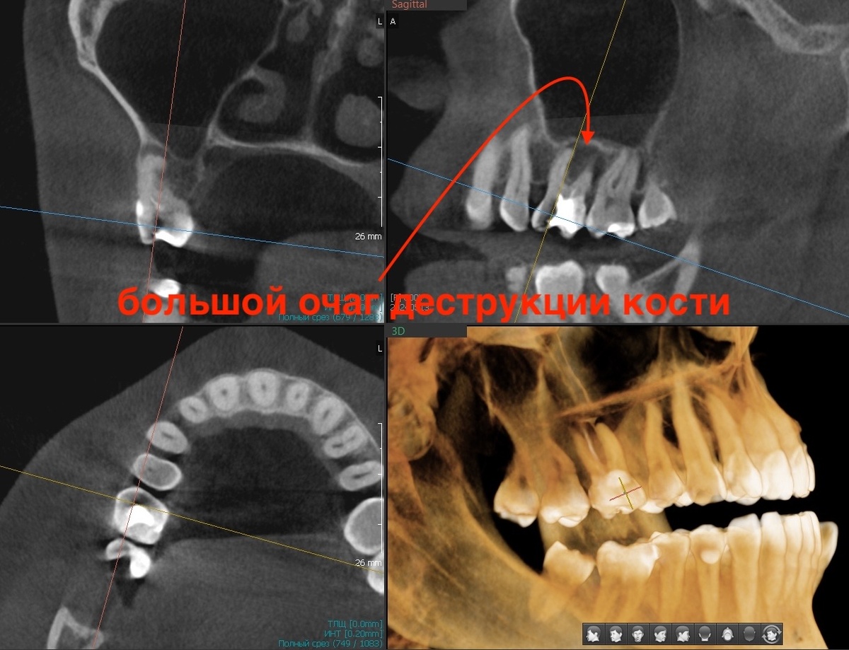 Периодонтит 1.6 зуба, 2024 год