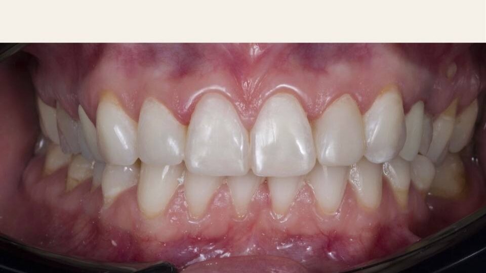 Если у вас потемневшие зубы, сколы или неровный край — это можно аккуратно и естественно исправить