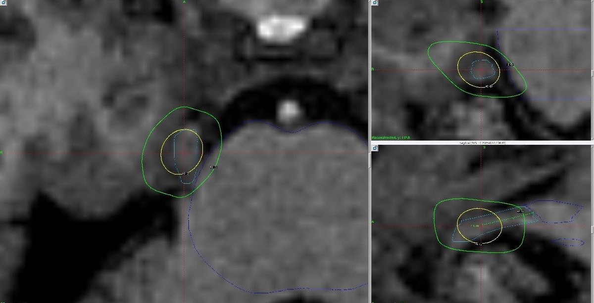 На фото: план обучения невралгии тройничного нерва.