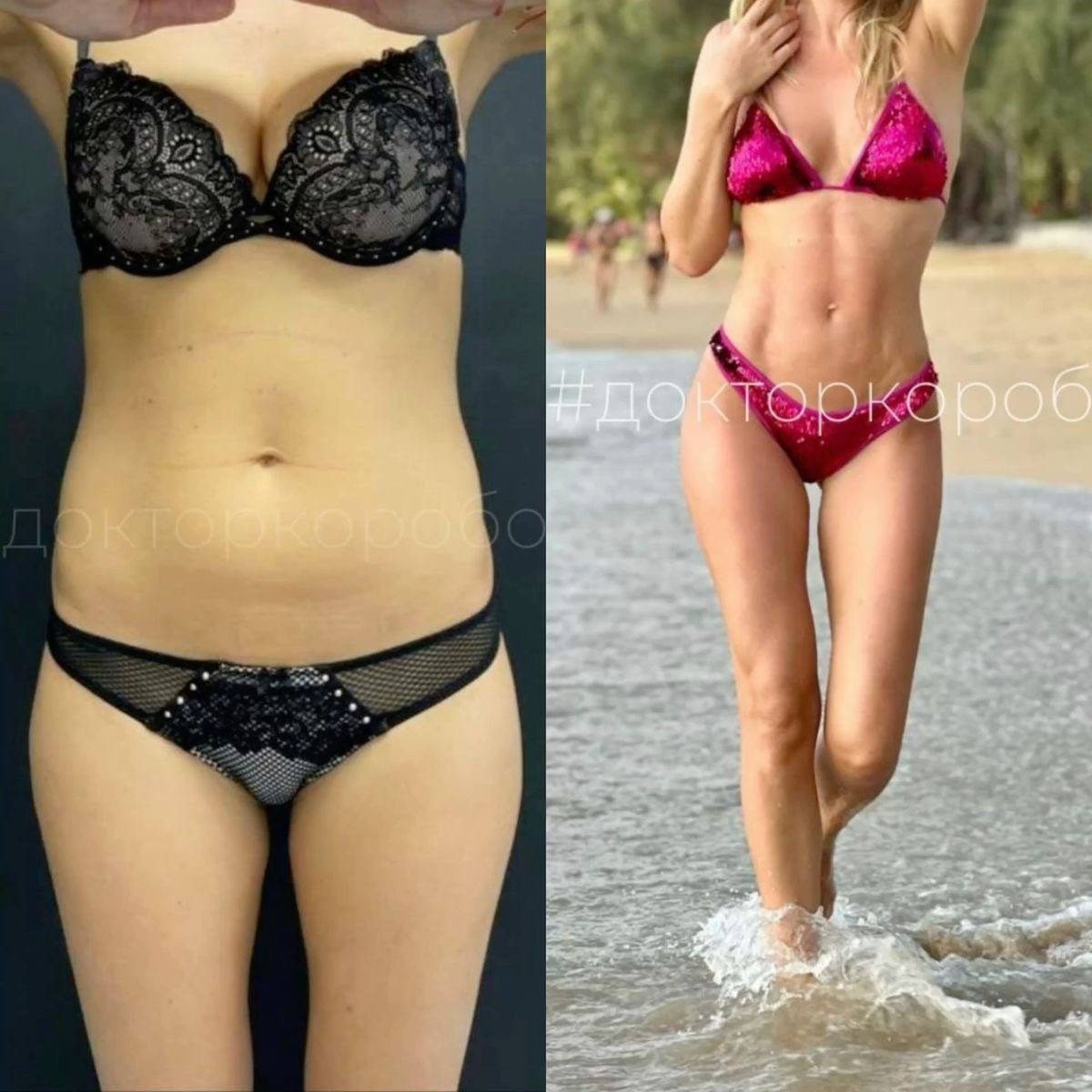 Липосакция живота с прорисовкой спортивных линий, липосакция пояснично - боковых областей. Результат через 2 года после операции.