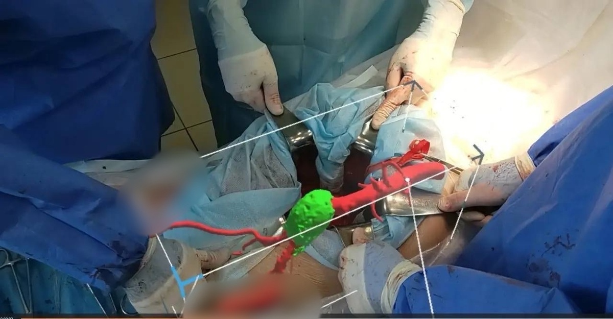    В Оренбургской больнице впервые в России провели операции при аневризмах аорты с применением дополненной реальности