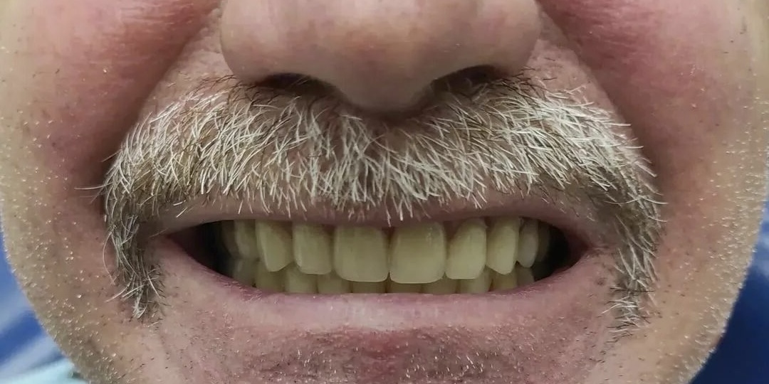 Мочевая кислота у пожилых: почему сложно заметить и 5 сигналов, которые не стоит игнорировать