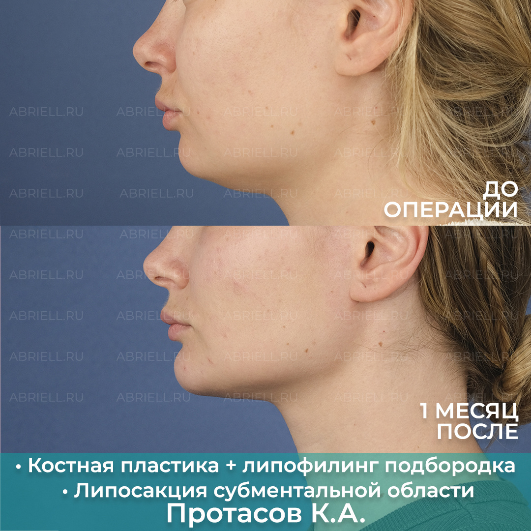 Пластика подбородка без имплантов / Протасов Кирилл Андреевич Пластический хирург в СПб