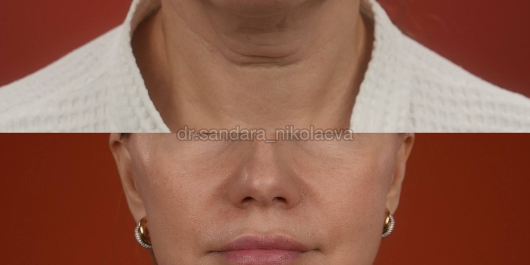 4,5 месяца после фейслифтинга, повторной верхней блефаропластики с лазерной шлифовкой