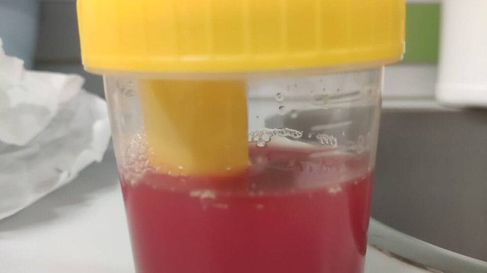 Геморрагический цистит