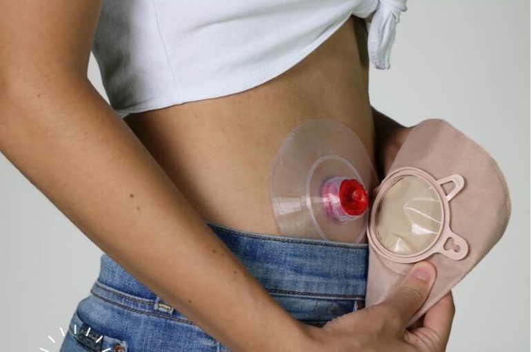 Почему выпадает стома?