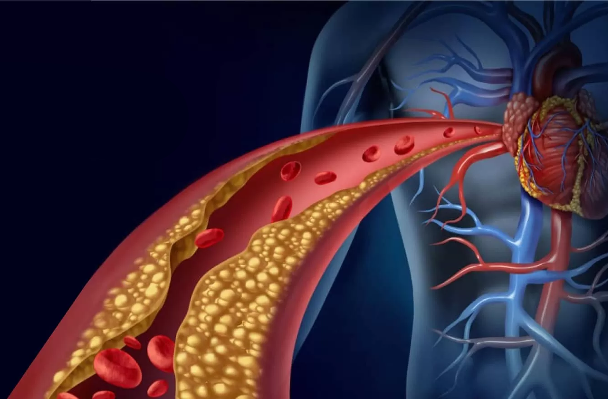 Эксперты ACC и AHA обновили рекомендации по ведению пациентов с дислипидемией