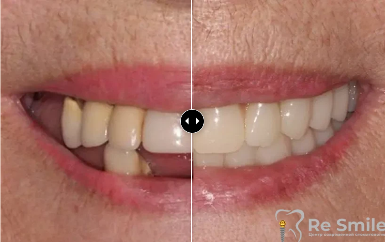 Пациентка обратилась с жалобами на частичное отсутствие зубов и неудовлетворительную эстетику.

Было проведено снятие металлокерамических конструкций, удаление несостоятельных зубов и корней на верхней и нижней челюстях с одномоментной имплантацией "all on 8" на верхней челюсти и "all on 8" на нижней челюсти с немедленной нагрузкой металлопластиковыми протезами на верхней и нижней челюстях.