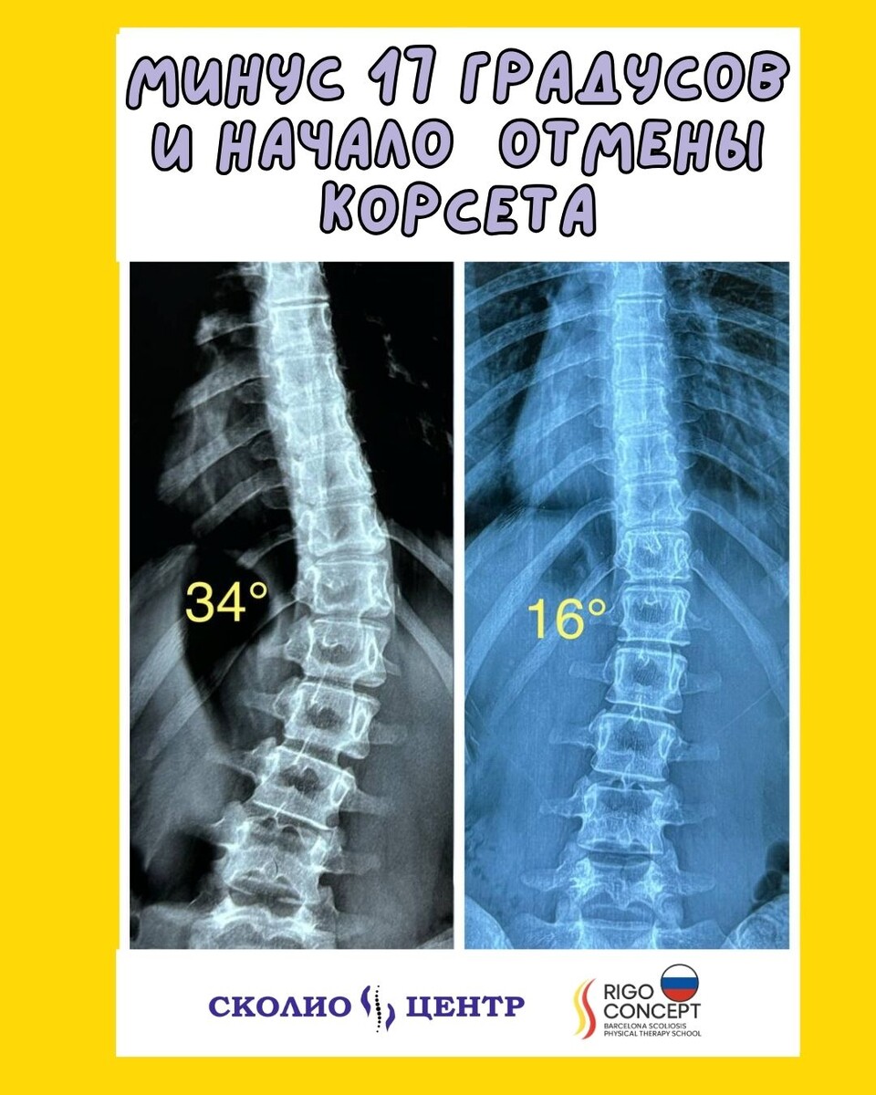 Кейсы Сколио Центра СПб