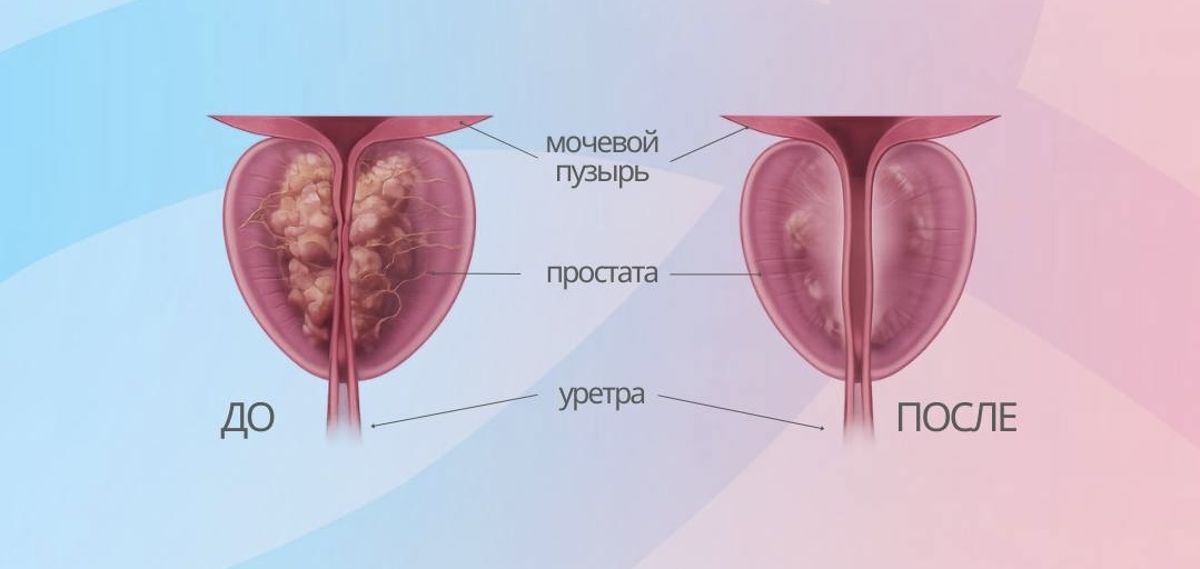 До и после водно-паровой терапии Rezum.ИМЕЮТСЯ ПРОТИВОПОКАЗАНИЯ. ТРЕБУЕТСЯ КОНСУЛЬТАЦИЯ СПЕЦИАЛИСТА. 