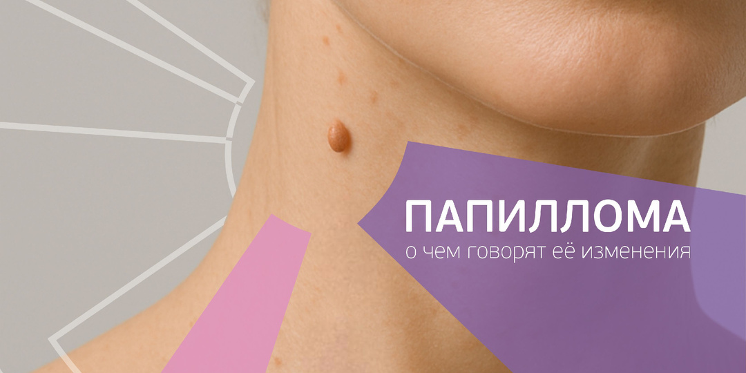 Папиллома воспалилась, болит или изменила цвет?