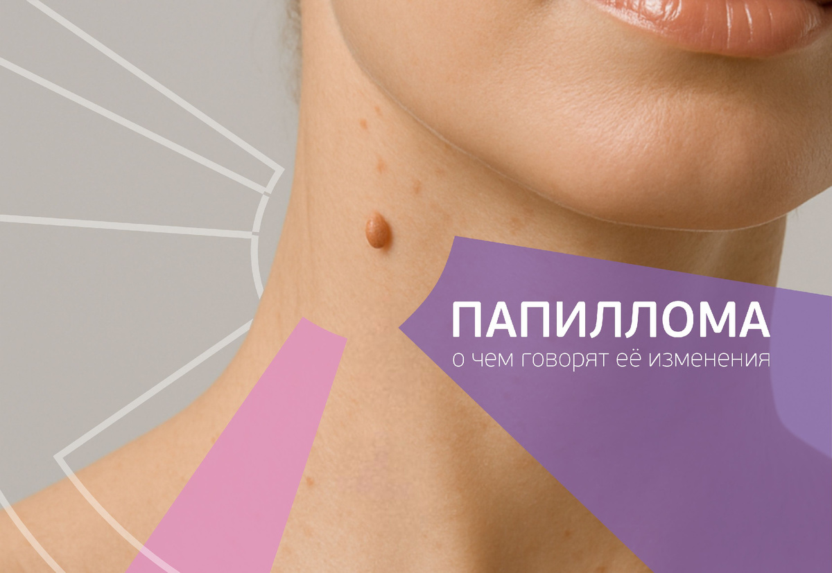 Папиллома воспалилась, болит или изменила цвет? Когда нужно срочно к хирургу