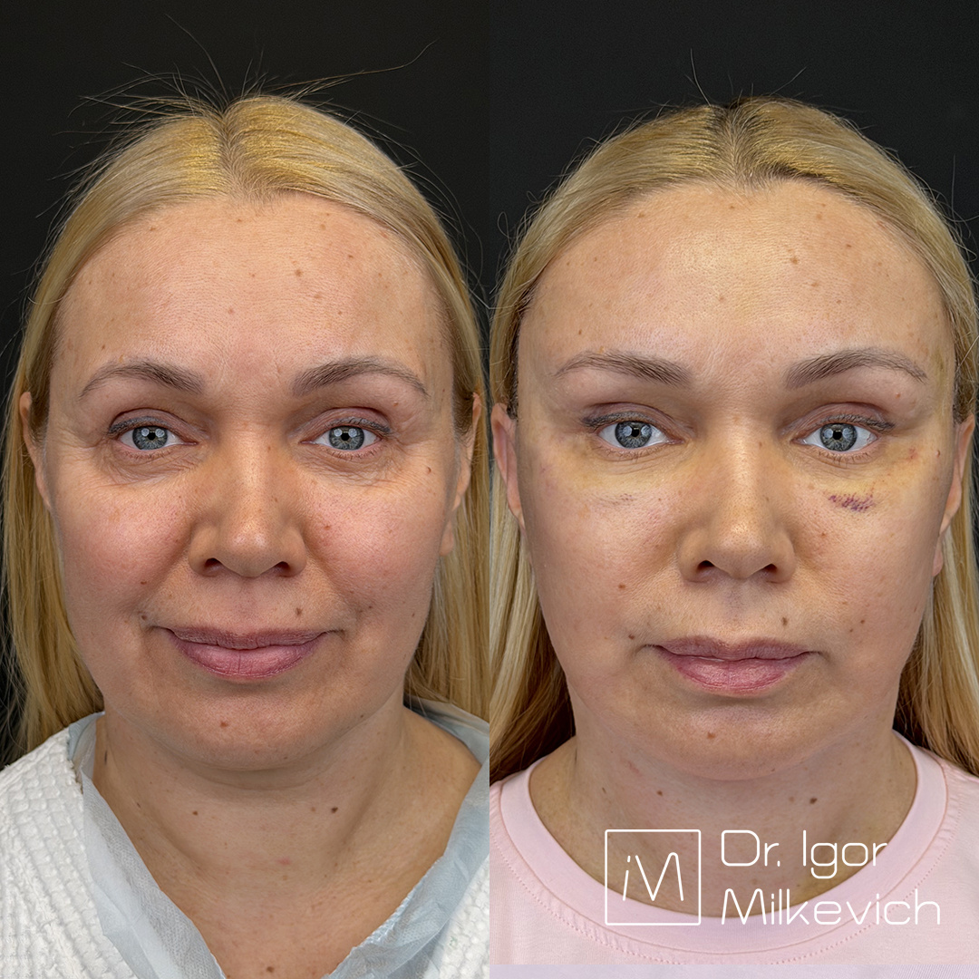 Неделя после круговой подтяжки лица