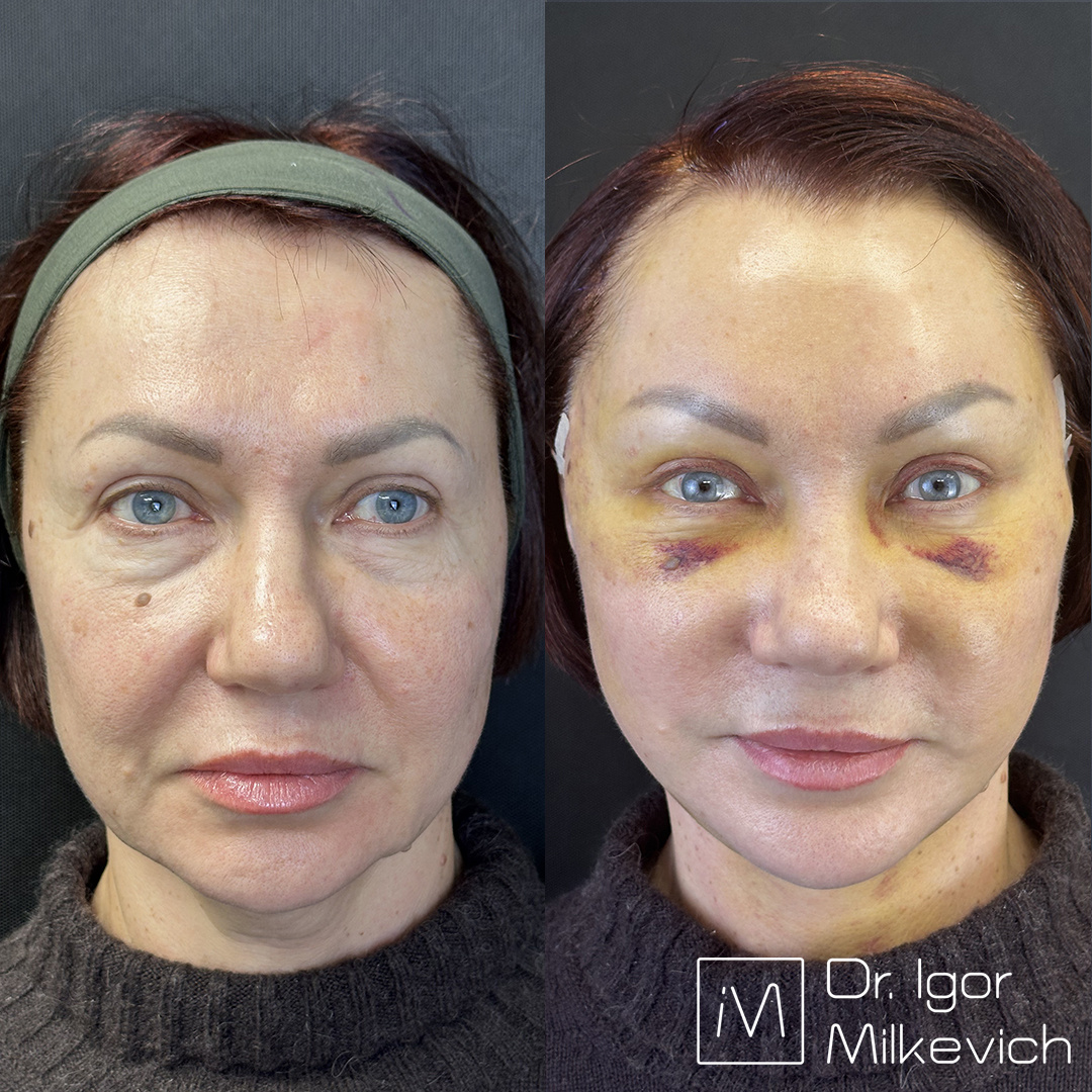 5 дней после круговой подтяжки лица