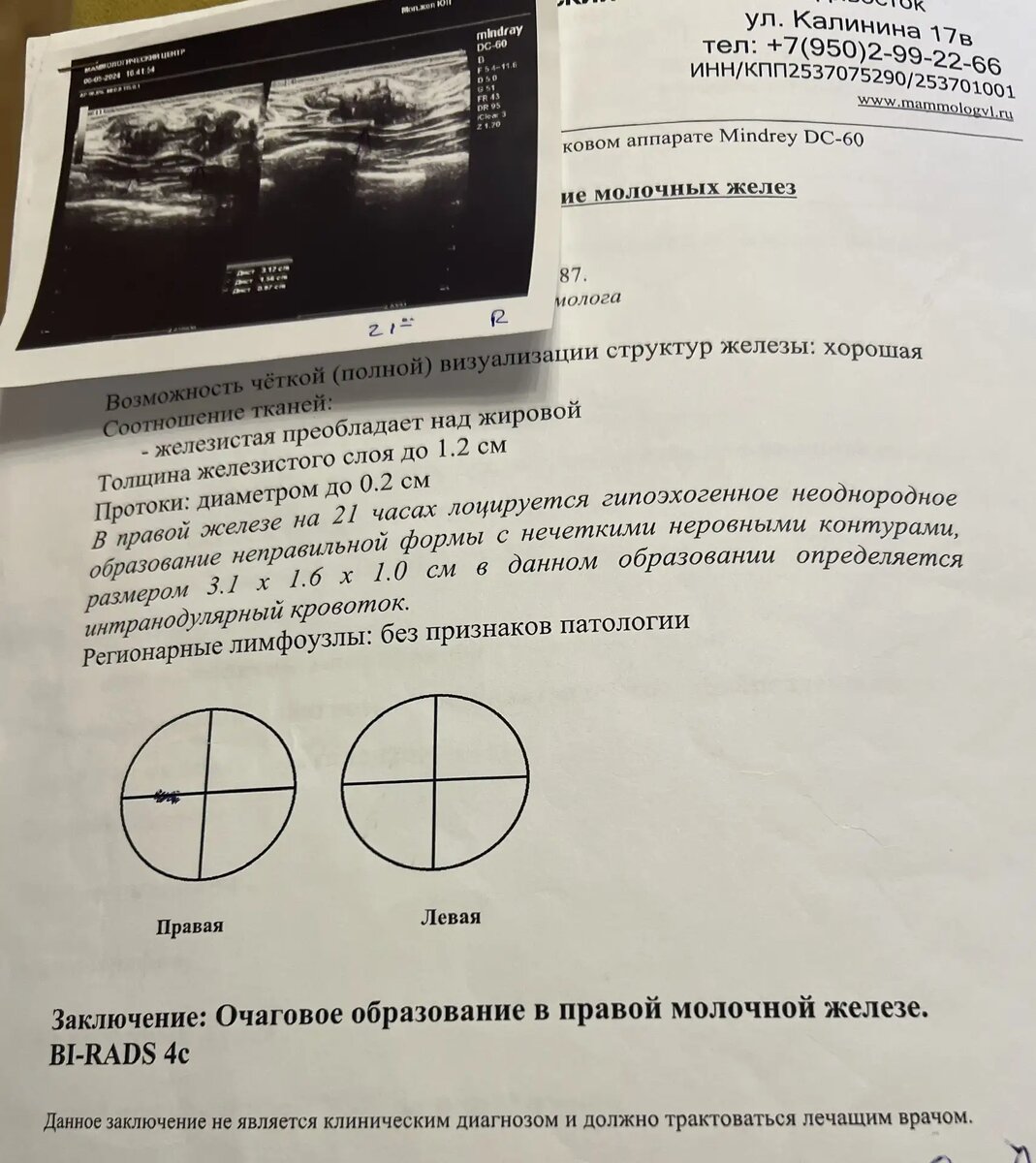 Результаты УЗИ 2024 год. Если в своем заключении увидите BI-RADS 4 - это повод не откладывать обследование на потом. 