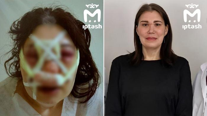 Хирурги Челнов собрали череп девушки из 30 осколков после зверского избиения. Фото © Telegram / Mash Iptash