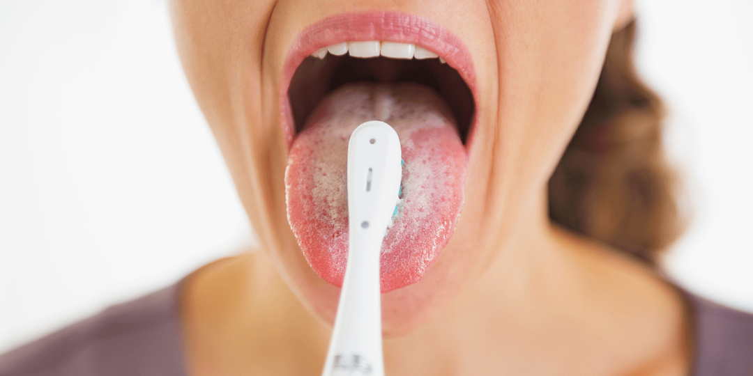 Кандидоз во Рту у ребенка и взрослых. Признаки молочницы ротовой полости