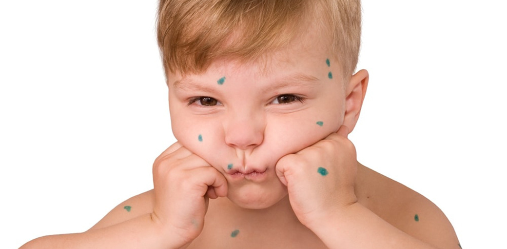 А вдруг у нас ветрянка?!