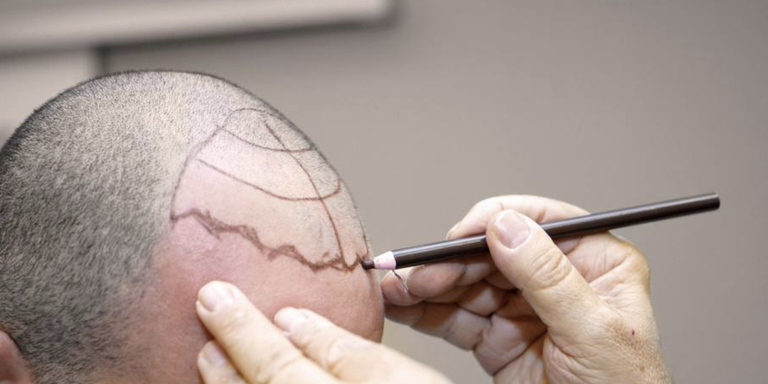 Пересадка волос в России 2026: полный гид по ценам, городам и технологиям