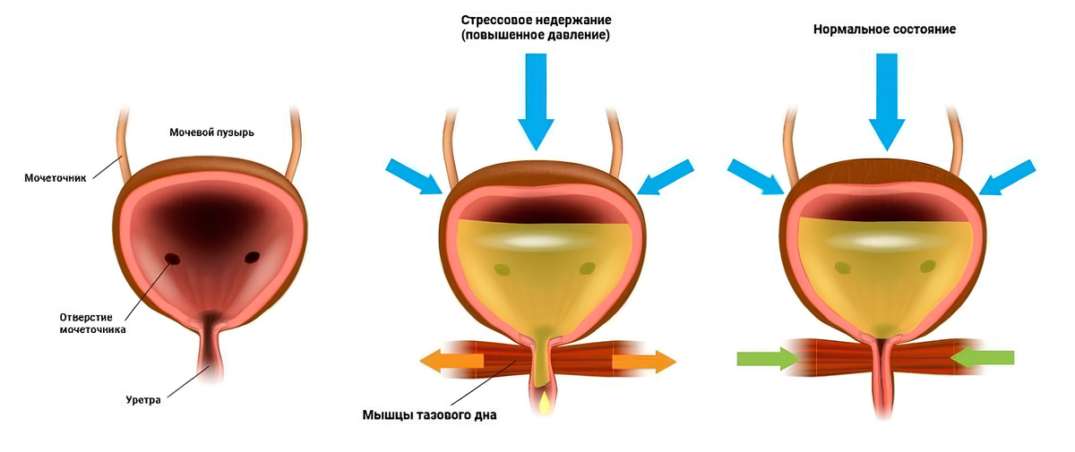 Схема: этапы работы мочевого пузыря в процессе мочеиспускания.