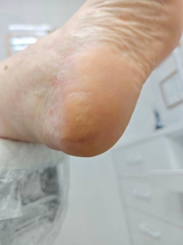 после одной обработки