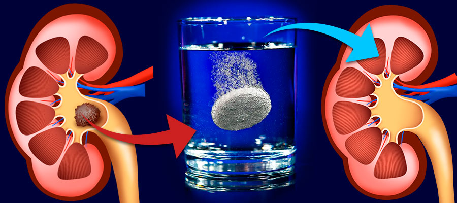 Удаление камней в почке без операции!