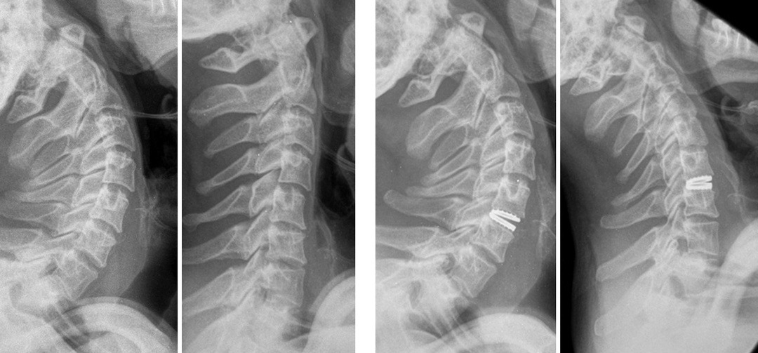 Возвращение к активной жизни после эндопротезирования диска