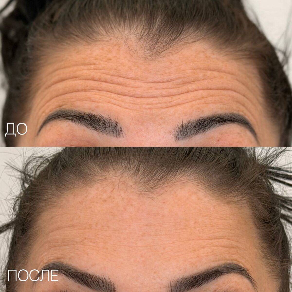 Результаты "До/После" процедуры ботулинотерапии 