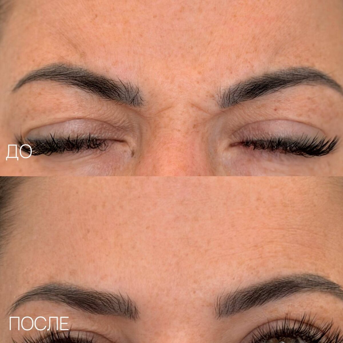 Результаты "До/После" процедуры ботулинотерапии 